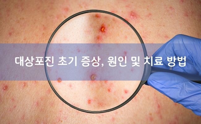 Read more about the article 대상포진 초기 증상, 원인, 무서운 이유